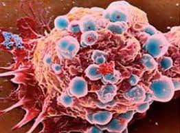 Mỗi[-]ng&agrave;y[-]Việt[-]Nam[-]c&oacute;[-]260[-]người[-]chết[-]v&igrave;[-]ung[-]thư